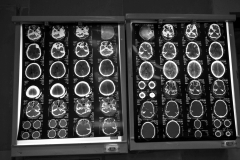 The M.R.I of the person, who has become brain dead, and the diagnosis of his being brain dead .The family of the brain dead person, can donate the body parts to people in need indeed, and give them a new life.In a hospital in Tehran.Jan 2014.