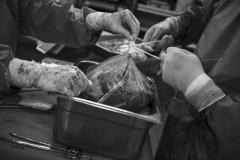 The organ ( lung ) is removed from the body by Doctors to be donated to save a life. In a hospital in Tehran, 05 July 2016.